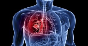estudio-genetico-cancer-pulmon